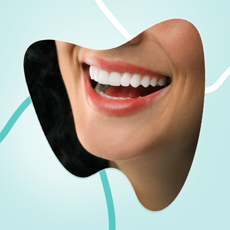 Clareamento dental caseiro ou a laser: qual é o melhor para meu sorriso?